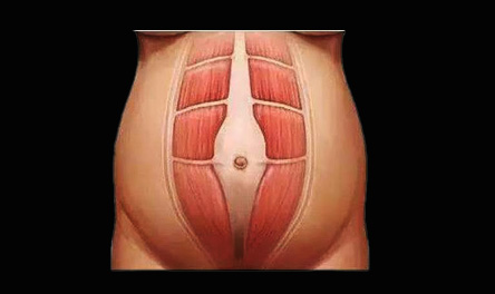 Behandlung der Trennung von Rectus Abdominis: