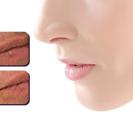 Lippenhaarentfernung: